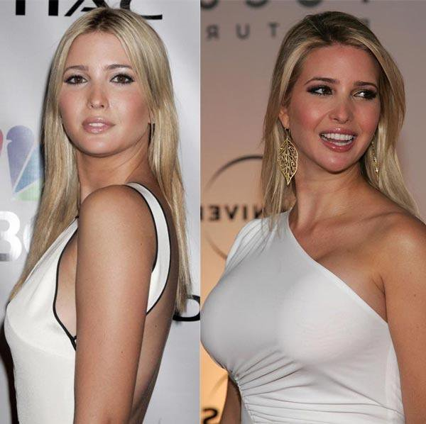 Trump bought Ivanka a pair of huge breast implants