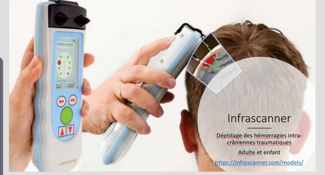 Dépistage des hémorragies intra-crâniennes traumatiques
Adulte et enfant #hcsmeufr #hopital20 #hopital #urgence #innovation #esante #samu