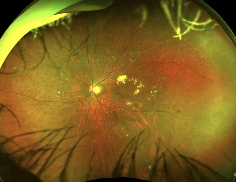 Why Pay for #COPE Credits? Local In-person Complimentary #CE Dinner Program: "Then, Now, and Tomorrow: Evolving the Management of Diabetic Retinopathy and the Role of the Optometrist" Register now! hubs.ly/H0m2rkW0 <a href="/EvolveMedEd/">Evolve Medical Education LLC</a>