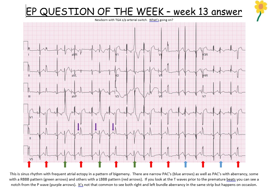 Here's the answer to last weeks ECG of the week . . . #ECGchallenge #ECGoftheweek #PediatricECG