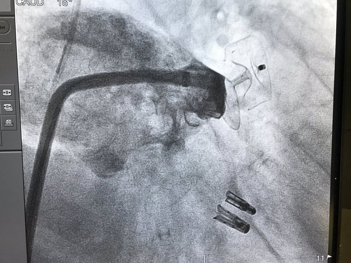 Hemodin_LaPaz's tweet photo. Another day in the lab...82 yo male with primary #MR #AF and contraindication for oral anticoag. 2 #Mitraclips and #LAAC in the same procedure. Good final result! @RaulmorenoMD @hemodin90 @AJuradoRoman #DrJimenezValero @shci_sec https://t.co/SdfQAREYRu
