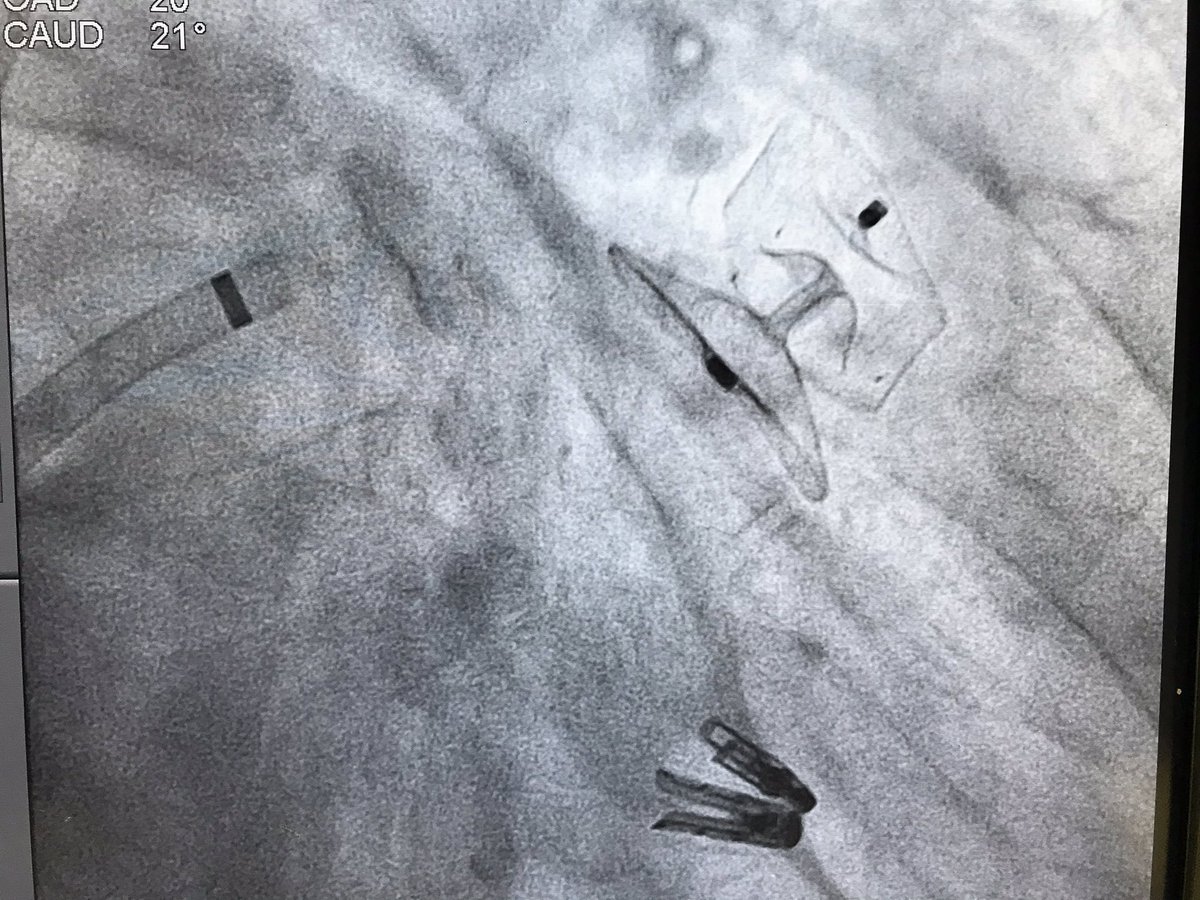 Hemodin_LaPaz's tweet photo. Another day in the lab...82 yo male with primary #MR #AF and contraindication for oral anticoag. 2 #Mitraclips and #LAAC in the same procedure. Good final result! @RaulmorenoMD @hemodin90 @AJuradoRoman #DrJimenezValero @shci_sec https://t.co/SdfQAREYRu