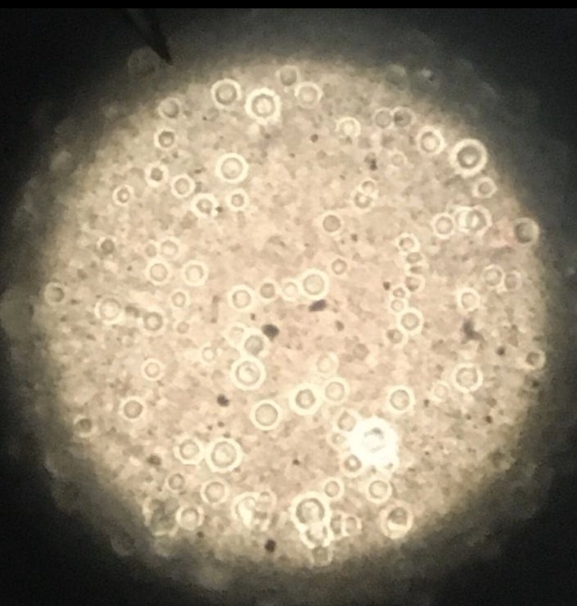 vida_ruiz's tweet photo. #IDDailypearl
HIV+men 30y/Fever/dyspnoea
history of abandonment of ARV treatment/ skin lesions SK
+ blood culture w/yeasts
Fatal fulminant cryptococcemia
Kaposi sarcoma
#IDpic
#MedTwitter
#IDtwitter
#fungus
#criptococosis
#kaposi https://t.co/so9hvogTvE