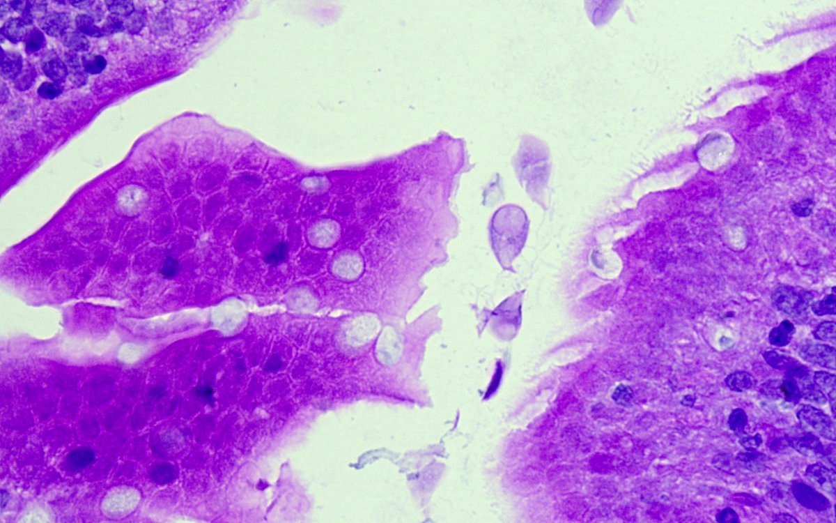 hematogones's tweet image. What the... who spilled corn flakes all over my duodenal biopsy?

WSI: the.pathology.network/share/8850556e…

#pedipath #gipath #idpath