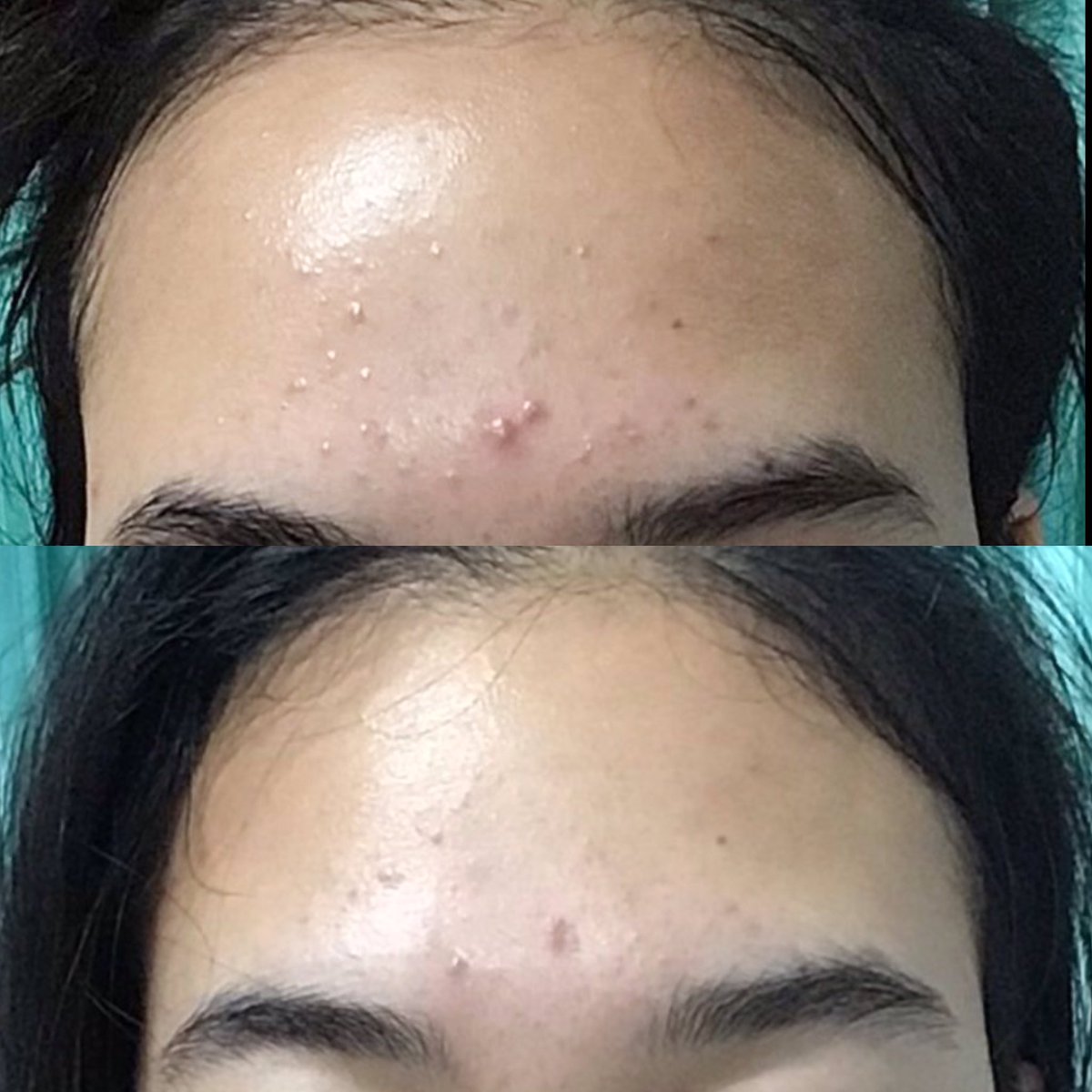 worasuda89's tweet photo. ดูรีวิวมาเยอะ รู้จัก #ยูเซอรีน มานาน แต่ไม่เคยใช้สักที ทำไมไม่ใช้ไม่รู้ งง จนอาทิตย์ก่อนอะไรดลใจให้ได้ลองใช้ คือค้นพบว่านั่นแหละค่ะ ดีสมเสียงลือเสียงเล่าอ้างอันใดกัน ชอบที่สุดคือควา��คุมมัน คือหน้ามันน้อยลง ชอบ ชอบ ชอบ!! ใช้เงินซื้อเองนะ  อยากให้ลองจริงๆ #ไว้รีวิวห้ามขายของโว้ยย https://t.co/2rlq4AR5eI