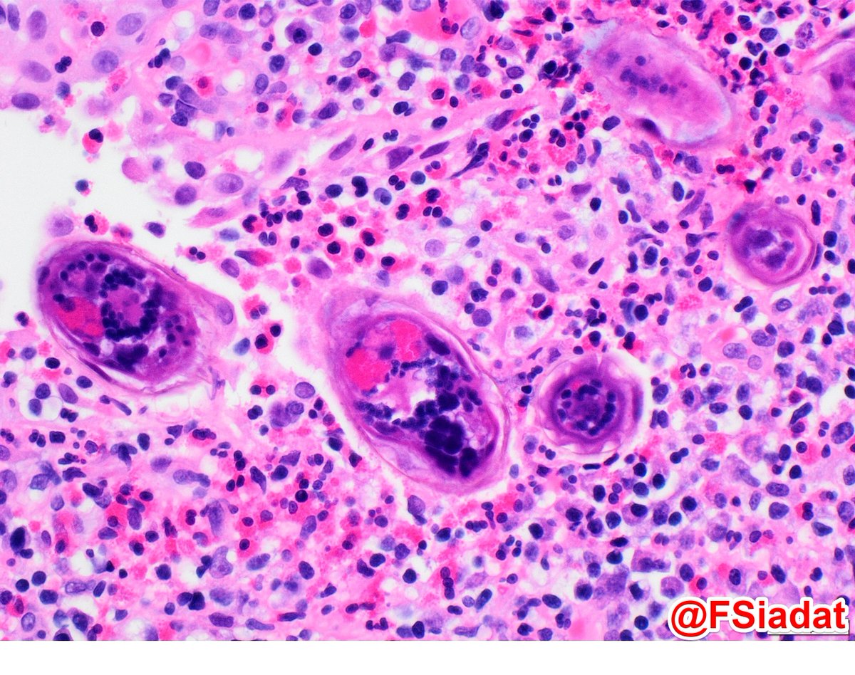 FSiadat's tweet photo. Schistosomiasis-associated cystitis. Urothelium may show a wide range of reactive, hyperplastic, and metaplastic changes. The credit goes to one of my smart colleagues who diagnosed and shared the case. #gupath #bladder #pathology https://t.co/nxBzklMDAO