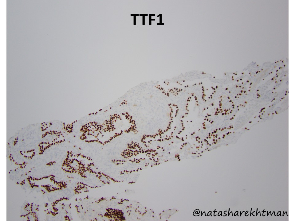 🔬 Hi <a href="/pathology/">pathology</a> friends! Ready for the next #natpathpuzzler 🧩?  Well… here it is. Biopsy of a lung nodule in a patient with renal mass. Here is TTF1. Thoughts? Would you get any other stains?