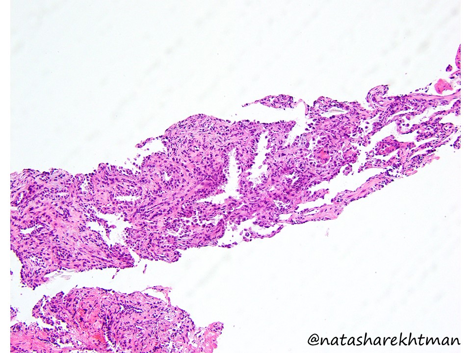 natasharekhtman's tweet photo. 🔬 Hi @pathology friends! Ready for the next #natpathpuzzler 🧩? Well… here it is. Biopsy of a lung nodule in a patient with renal mass. Here is TTF1. Thoughts? Would you get any other stains? https://t.co/a99iXxiVgP