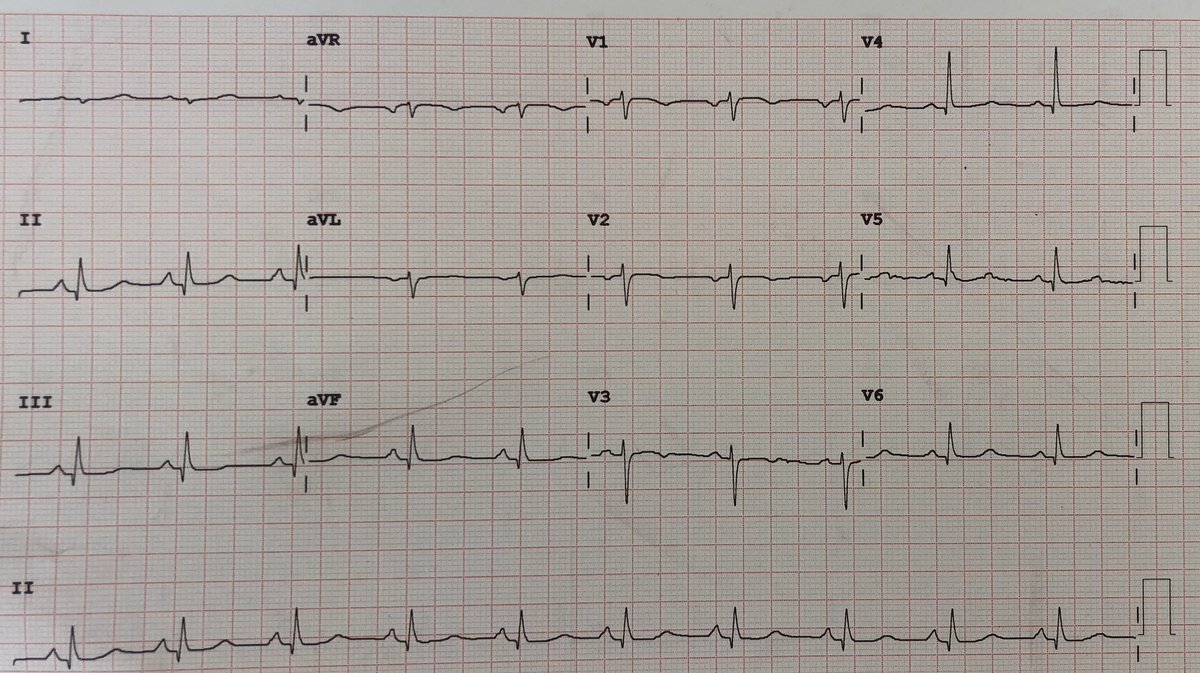 jvillacastin's tweet photo. Varón de 25 años que sufre un síncope mientras realizaba un esfuerzo máximo en bicicleta. Se recupera con ligero traumatismo y se realiza electrocardiograma. No síntomas previos.Que pruebas recomendarías? https://t.co/ltBtmERWMj
