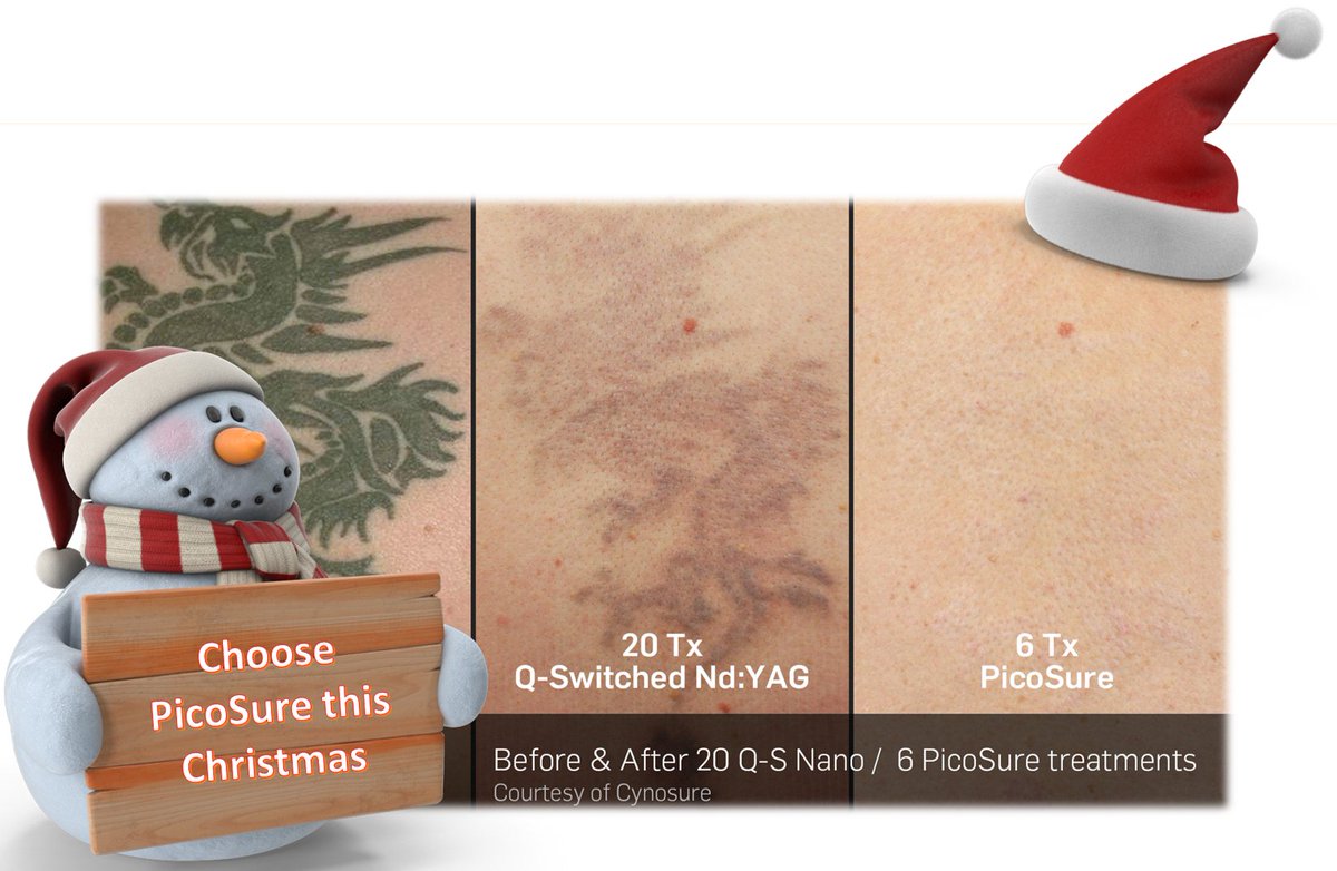 🎅 Try Tattoo removal this christmas with #picosure  🎅 
Why not get all three tattoos removed and get one free? At #juvea we use #picosure, the world's fastest #picosecondlaser 
📧 info@juveaaesthetics.com 
📞020 7291 4554