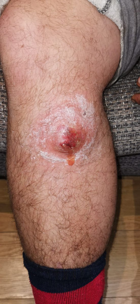 This is why dogs should never be allowed on playing fields. This is the leg of one of our 1st XV players after dog mess got into a cut during a game. If it doesn't improve by Monday he's going to have to have surgery to clean it out.

KEEP DOGS OFF PLAYING FIELDS