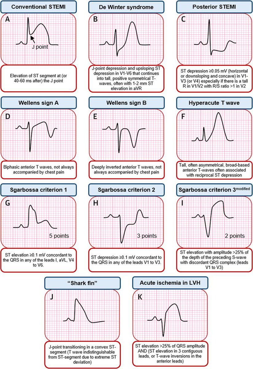 Electrocardiographic Diagnosis of Life-Threatening STEMI Equivalents by Dr. Babken Asatryan 
#JACCCaseReports casereports.onlinejacc.org/content/early/…

<a href="/JACCJournals/">JACC Journals</a> <a href="/DrAJRestrepo/">Alejandro Jimenez Restrepo</a> <a href="/jacabreracardio/">Dr. José Ángel Cabrera</a> <a href="/majazayeri/">Ali Jazayeri MD</a> <a href="/bogdienache/">Bogdan Enache</a> <a href="/rafavidalperez/">rafavidalperez</a> <a href="/keaglemd/">Kim Eagle</a> <a href="/ACCinTouch/">American College of Cardiology</a> <a href="/MinnowWalsh/">Minnow Walsh, MD, MACC</a> <a href="/mividovich/">Mladen Vidovich</a>