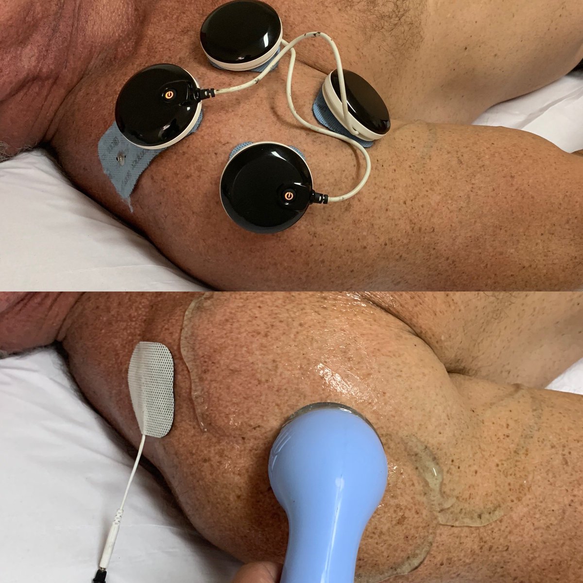 fisioaction's tweet photo. Tratamento tendinite ombro com Tens Compex e Terapia Combinada de Ultra Som e Corrente Interferencial ... https://t.co/Xj0PMkCcHg