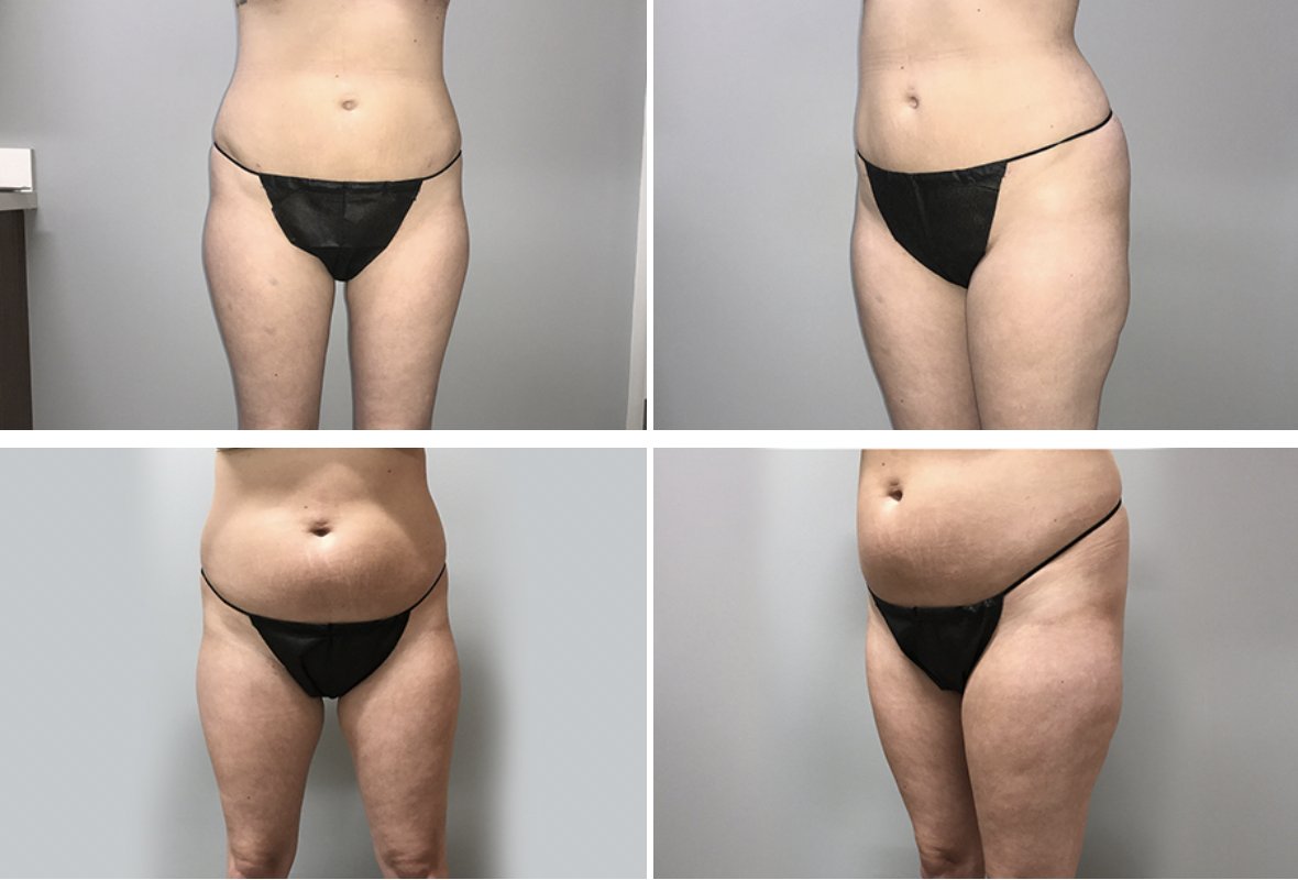 DiFrancescoMD's tweet photo. #Before &amp; #After | Let the double-board certified, award-winning #Breast and #Body Expert, Dr. Lisa DiFrancesco, change your life! This incredible #bodytransformation is thanks to Dr. D's knowledge and expertise, and our patient could not be happier. Request a consultation today! https://t.co/WGhoiL7pOL