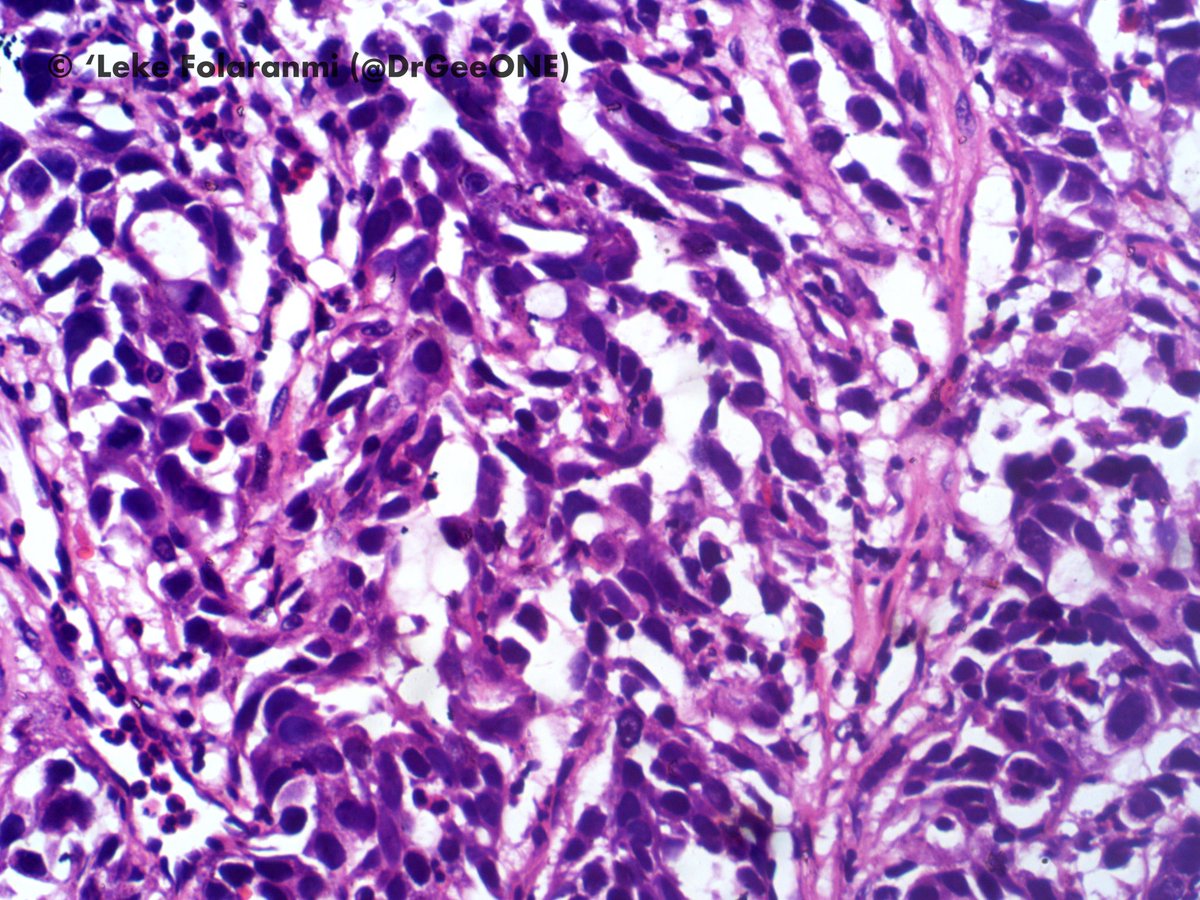 DrGeeONE's tweet photo. Biopsy of oesophageal mass close to the LES in an elderly patient.
“squamous” cells with discohesive pattern and ?pseudoglandular areas
Any vote for acantholytic SCC?
Your opinions are welcome!
#Gipath
@RunjanChetty @ariella8 @tralimiguel @kis_lorand @Voltaggiol @emma_furth https://t.co/5iQSrKkgaX