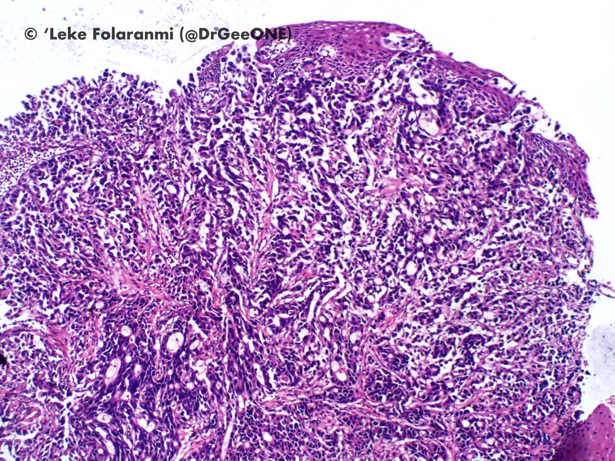 DrGeeONE's tweet photo. Biopsy of oesophageal mass close to the LES in an elderly patient.
“squamous” cells with discohesive pattern and ?pseudoglandular areas
Any vote for acantholytic SCC?
Your opinions are welcome!
#Gipath
@RunjanChetty @ariella8 @tralimiguel @kis_lorand @Voltaggiol @emma_furth https://t.co/5iQSrKkgaX