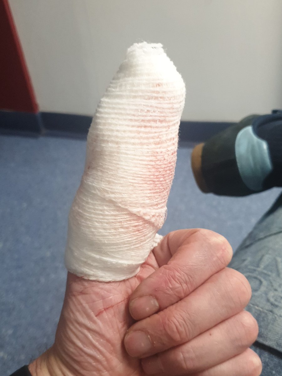 Sat in casualty waiting to be  seen lol 
#pudseyjoinery #EBAcircle #thumbsup