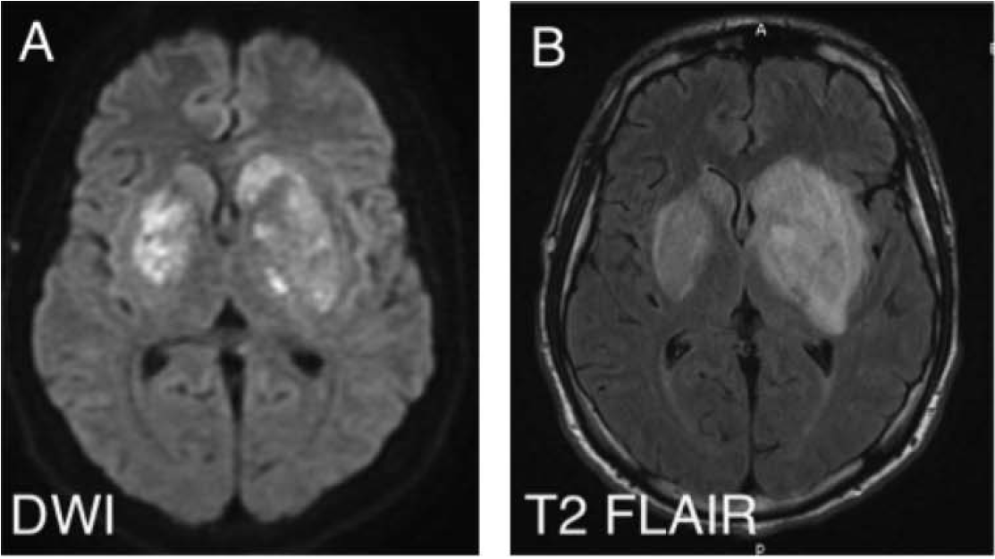 Part 1 of 2 | MCQ in 2nd Part 2:23M active IV heroin user p/w 4 d fever/headache/seizure. Temp 39.3, supple neck. Initial head CT (-). CSF: WBC 30 (60% L), TP 90, gluc n/l. Developed R arm/leg hemiparesis hospital day 5. MRI: large L>R b/l basal ganglia enhancing lesions ()