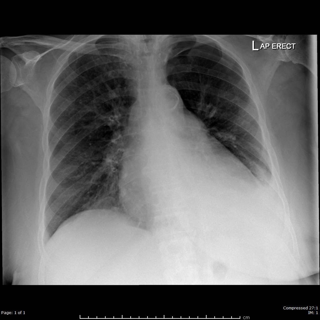 2/10 Pt improved & weaned off NIV by day 4, and maintained on 1L/min O2 to achieve saturation of 88-92%. On day 5, deteriorated with worsening SOB and hypoxaemia but non drowsy. The latest CXR now is shown here: