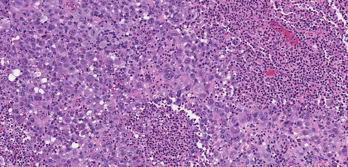 John Gross, MD (@jmcmahong) on Twitter photo LANGERHANS CELL SARCOMA: Rare tumor of dendritic family often in dermis/subcutis. Sheets of bizarre pleomorphic/epithelioid cells. Rare dx not to forget about! (+) Langerin, S100, CD1a. #bstpath <a href="/JMGardnerMD/">Jerad Gardner, MD</a> @histiocytosisX <a href="/SteveBillingsMD/">Steven Billings, MD</a> <a href="/ScottLauerMD/">Scott Lauer, MD</a> <a href="/skinandsoftbits/">Rajiv M. Patel, M.D.</a> LANGERHANS CELL SARCOMA: Rare tumor of dendritic family often in dermis/subcutis. Sheets of bizarre pleomorphic/epithelioid cells. Rare dx not to forget about! (+) Langerin, S100, CD1a. #bstpath <a href="/JMGardnerMD/">Jerad Gardner, MD</a> @histiocytosisX <a href="/SteveBillingsMD/">Steven Billings, MD</a> <a href="/ScottLauerMD/">Scott Lauer, MD</a> <a href="/skinandsoftbits/">Rajiv M. Patel, M.D.</a>
