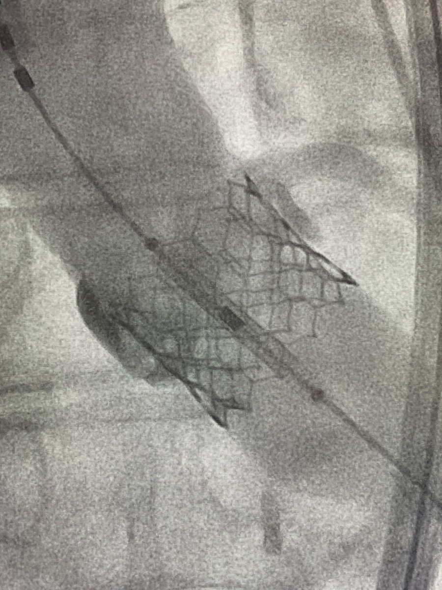 jcastelltwitt's tweet image. First transcaval TAVR in Baton Rouge. #transcaval #TAVR #Burn