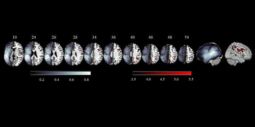 ASHAJournals's tweet photo. (4 of 6) Fourth article in the #JSLHR forum - #Neurocognitive Recovery of #Sentence Processing in #Aphasia, by Cynthia Thompson https://t.co/B7XPRcXtCZ #ASHA_Events #ASHA19 #slpeeps @SLPeeps #audpeeps @NorthwesternU https://t.co/VWwrkgsoX6