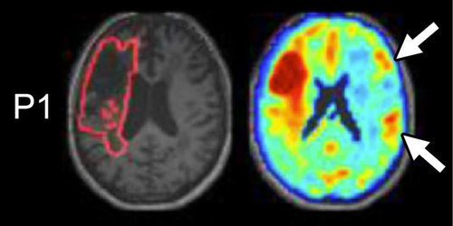 ASHAJournals's tweet photo. (5 of 6) Fifth article in #JSLHR forum - #Taxonomy of #Brain–Behavior Relationships After #Stroke, by Peter E. Turkeltaub https://t.co/LgZR0F0jky @gumedcenter @MedStarNRH #ASHA_Events #ASHA19 #slpeeps @SLPeeps #audpeeps #ASHAJournals https://t.co/Kwj1CxY9Ru
