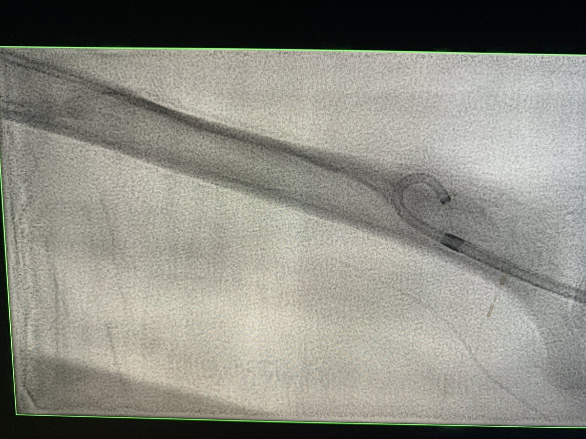 DrARJA_VIR's tweet photo. Occluded L AVF; thrombectomy CATD @penumbrainc L cephalic arch stenosis->9mm Viabahn improves outflow. Brachial artery embolus retrieved CAT6.gr8 flow n thrill infistula 👍🏻 see other images in thread @MNGHA_R_VIR @sirs_ksa @ASNKidney @SIRspecialists @BSIR_News @cirsesociety https://t.co/Cr8m2R81HR