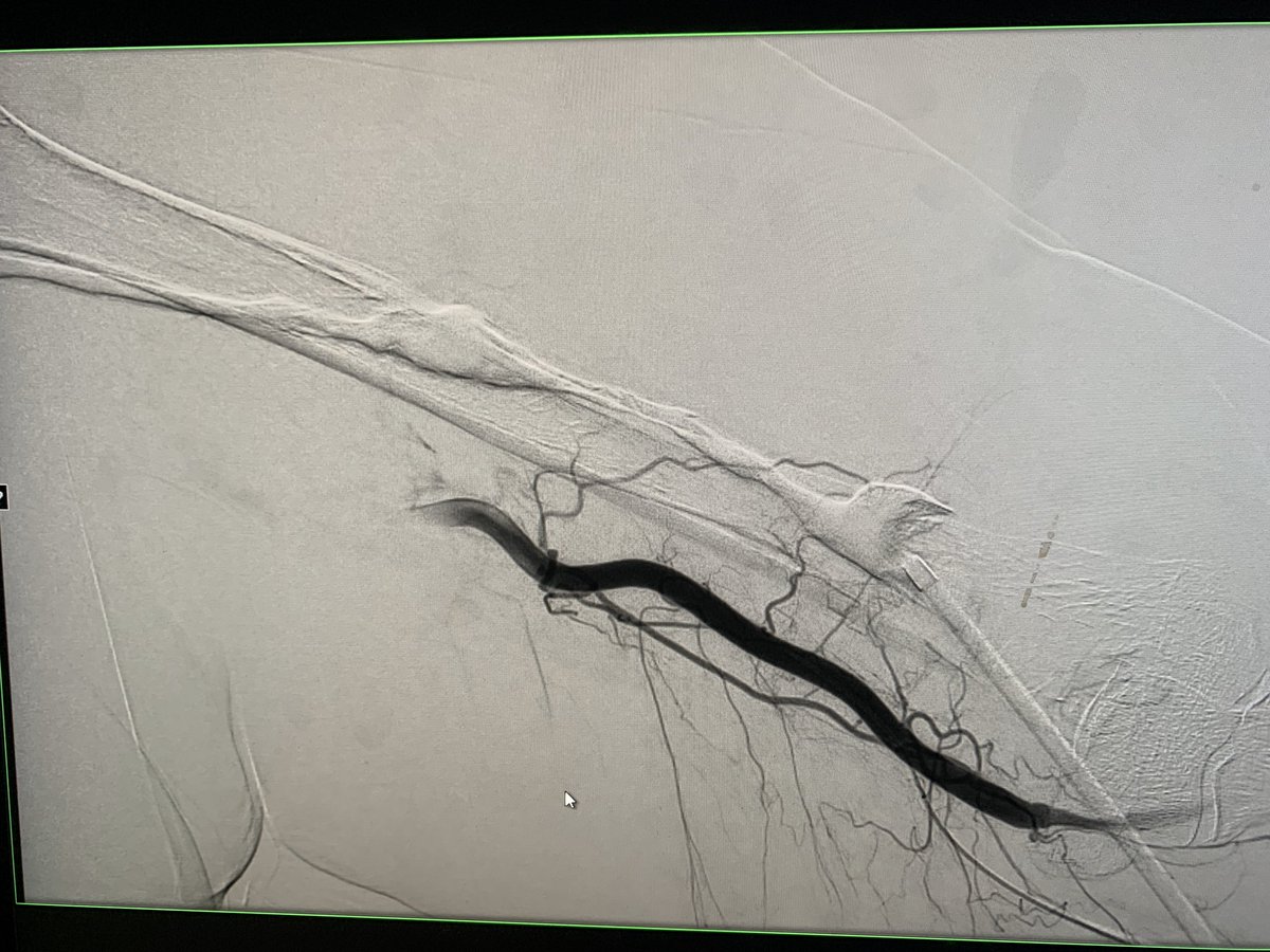 DrARJA_VIR's tweet photo. Occluded L AVF; thrombectomy CATD @penumbrainc L cephalic arch stenosis->9mm Viabahn improves outflow. Brachial artery embolus retrieved CAT6.gr8 flow n thrill infistula 👍🏻 see other images in thread @MNGHA_R_VIR @sirs_ksa @ASNKidney @SIRspecialists @BSIR_News @cirsesociety https://t.co/Cr8m2R81HR