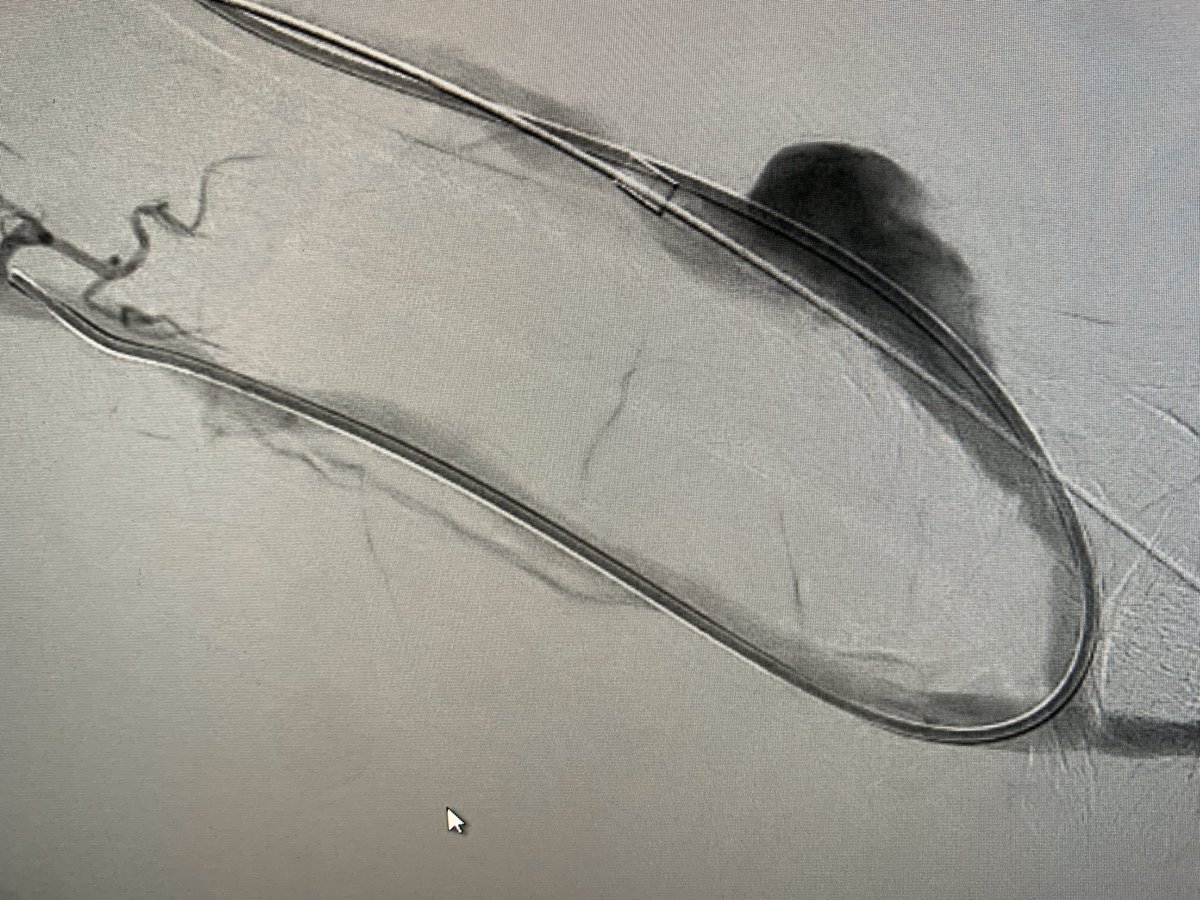 DrARJA_VIR's tweet photo. Occluded L AVF; thrombectomy CATD @penumbrainc L cephalic arch stenosis->9mm Viabahn improves outflow. Brachial artery embolus retrieved CAT6.gr8 flow n thrill infistula 👍🏻 see other images in thread @MNGHA_R_VIR @sirs_ksa @ASNKidney @SIRspecialists @BSIR_News @cirsesociety https://t.co/Cr8m2R81HR