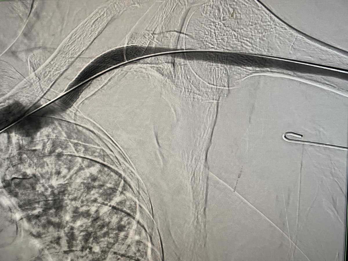 DrARJA_VIR's tweet photo. Occluded L AVF; thrombectomy CATD @penumbrainc L cephalic arch stenosis->9mm Viabahn improves outflow. Brachial artery embolus retrieved CAT6.gr8 flow n thrill infistula 👍🏻 see other images in thread @MNGHA_R_VIR @sirs_ksa @ASNKidney @SIRspecialists @BSIR_News @cirsesociety https://t.co/Cr8m2R81HR