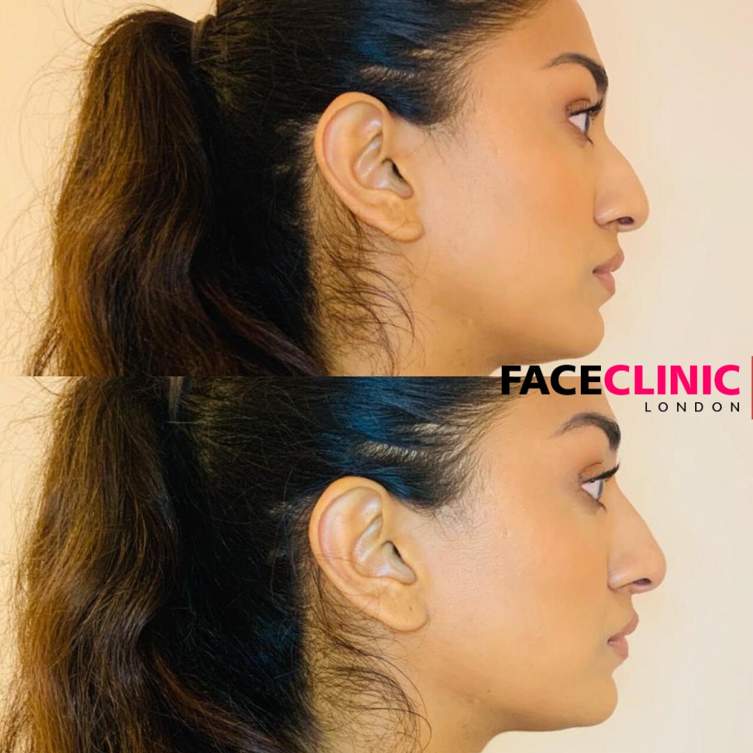 Face Clinic London on Twitter "Nose Reshaping. nonsurgicalrhinoplasty