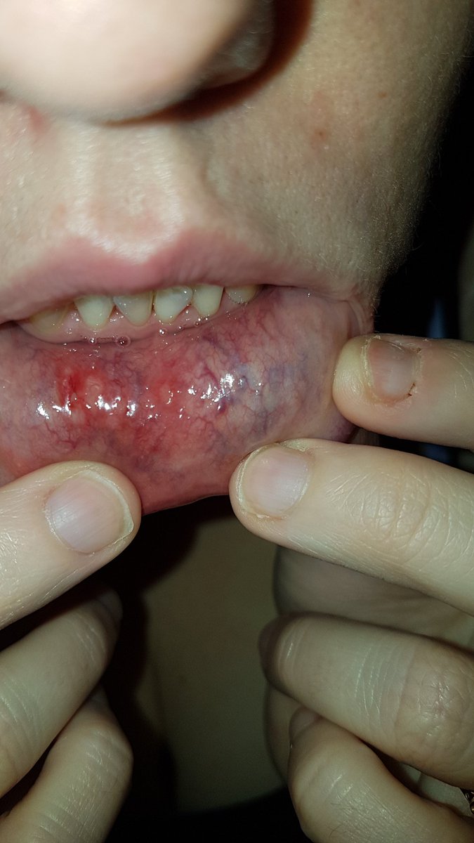 Woman gruesomely photographs 4 mouth ulcers and some minor bruising, on the inside of her.... cheek? chin?... below her mouth. Her nails are misshapen and/or chewed quite far down, and some cuticles may be bleeding and/or infected.