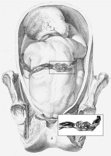 Umbilical cords can form knots!
I became interested when our first son (Z1) was born and finished the paper after our third (Z3)
Two simple models predict that 12-14 weeks of gestation is the most dangerous time for knot formation
Details in my 2004 paper https://bit.ly/2qv94EA