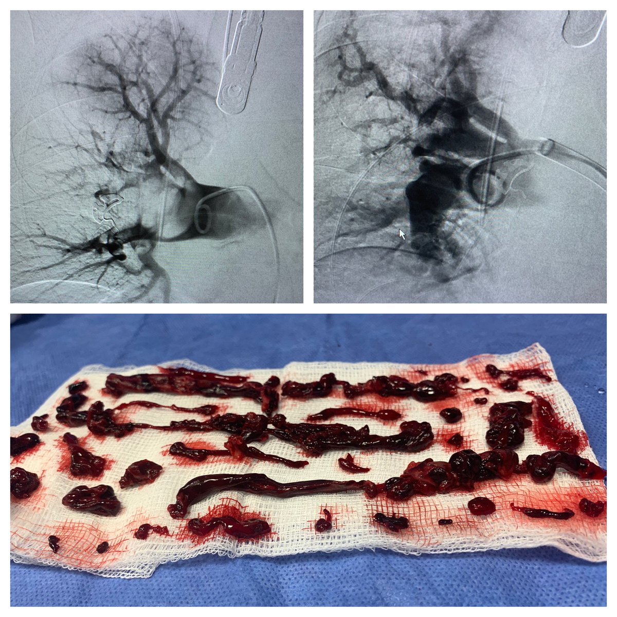 PE thrombectomy with Inari ClotTriever in a cancer patient with right heart strain.  Real time TEE  performed by anesthesia showed resolution of right heart strain immediately after thrombectomy. @WashUIR @SIRRFS @Seungkim89 @InariMedical