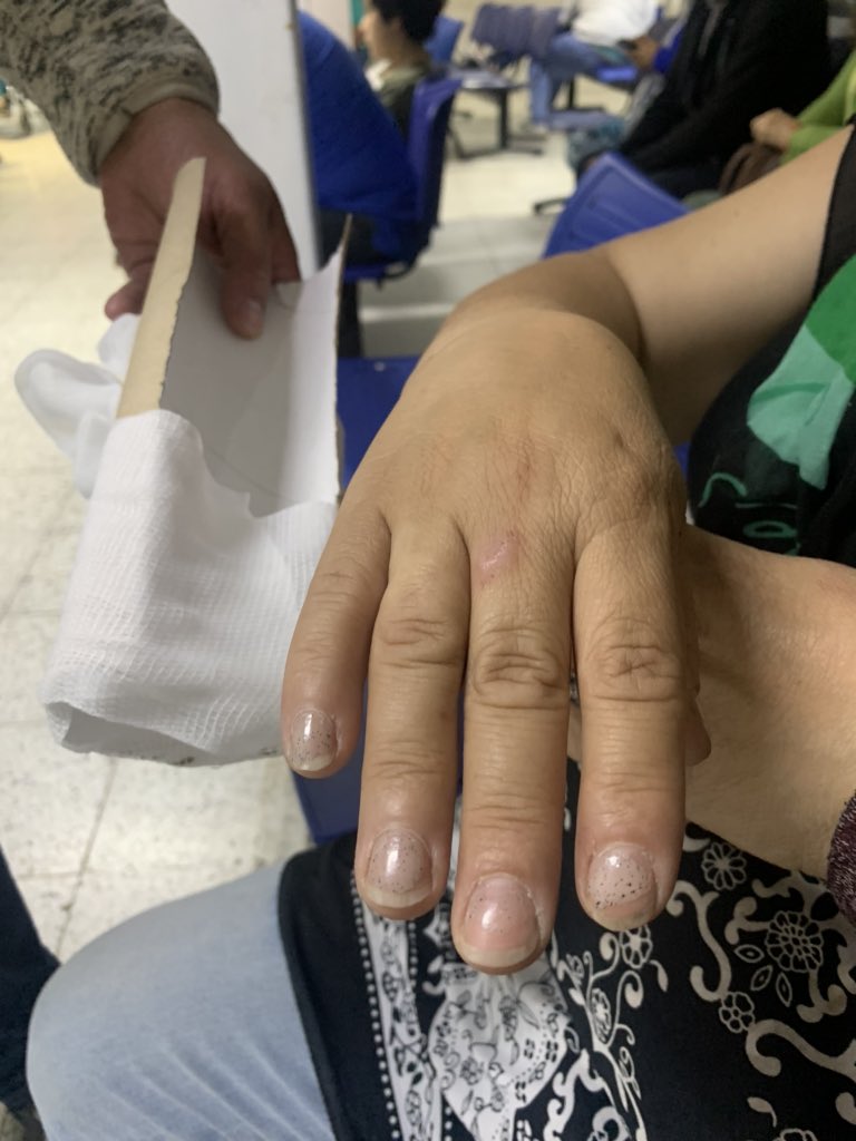 nalegriadiaz's tweet photo. Ministro @jmanalich ud. dijo q “nuestro sistema de salud es 1 de los mejores y + eficientes del planeta”. Pero, en el SAR N 1 de #Rancagua inmovilizan manos lesionadas con conos de toalla nova! Eso es eficiencia para usted? @alcaldesoto @eltipografo @elrancaguino @cl_juank https://t.co/w3f7ZJ9mmw