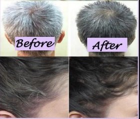 Permanent Hair Remov on Twitter: Permanent Hair Remov on Twitter: