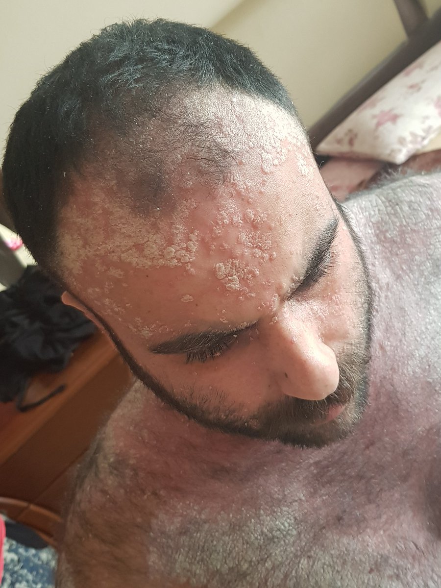 Ben gördügünüz gibi çok rahatsızım ne bir işte çalışa biliyorum nede topluma girebiliyorum tedavi olacak hiçbir durumum yok allah rızası için bana yardımcı olabirseniz ömür boyu duvacınız  olurum gerçekten hiç durumum yok maddi yönünden çooook sıkıntı içersindeyim