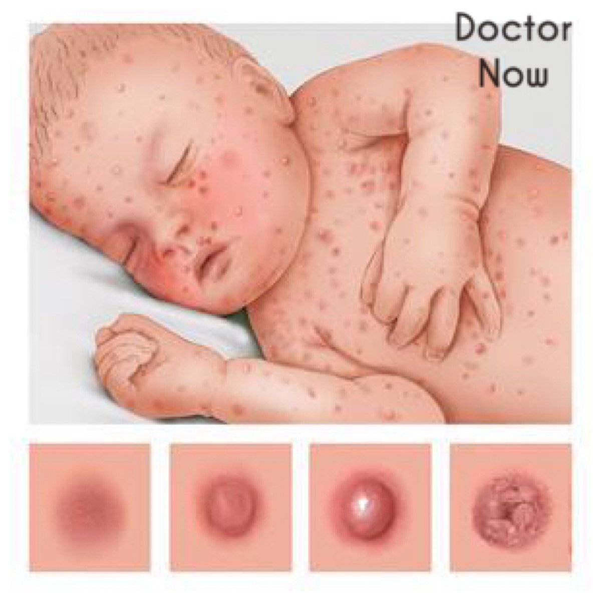 TheVaccineMom's tweet photo. Think a #chickenpox party is a good idea? Think again!! This highly #contagious #virus causes an itchy rash with small, fluid-filled #blisters can cause scaring. #Complications can be serious and even #fatal!
Photo cred: #DoctorNow https://t.co/MUgCojZVbS