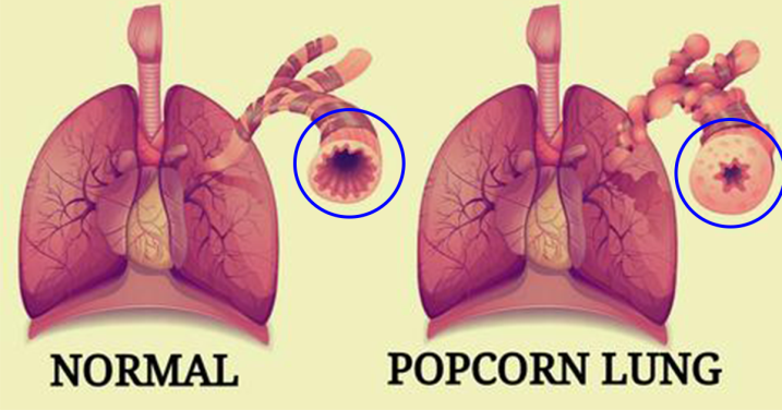 geekvape aegis solo 3 istruzioni Popcorn lung has been linked to the chemical found in e-cigarettes known as  diacetyl. It causes coughing, wheezing and shortness of breath. Read more  at https://t.co/P5hgfoIRFz #GetFitGP