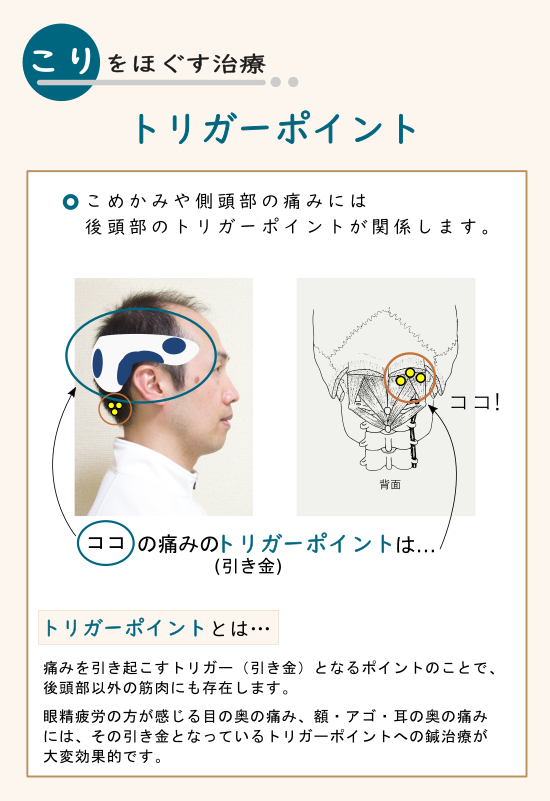 赤岩治療院 眼精疲労治療室 東京 渋谷区恵比寿 眼精疲労や頭痛 首の後ろの頑固なこりに トリガーポイント鍼治療を試してみませんか 眼精疲労の治療60分コース7 000円 T Co 1du1m4l42m 眼精疲労 目の疲れ 目が辛い 肩こり 頭痛 頭痛い