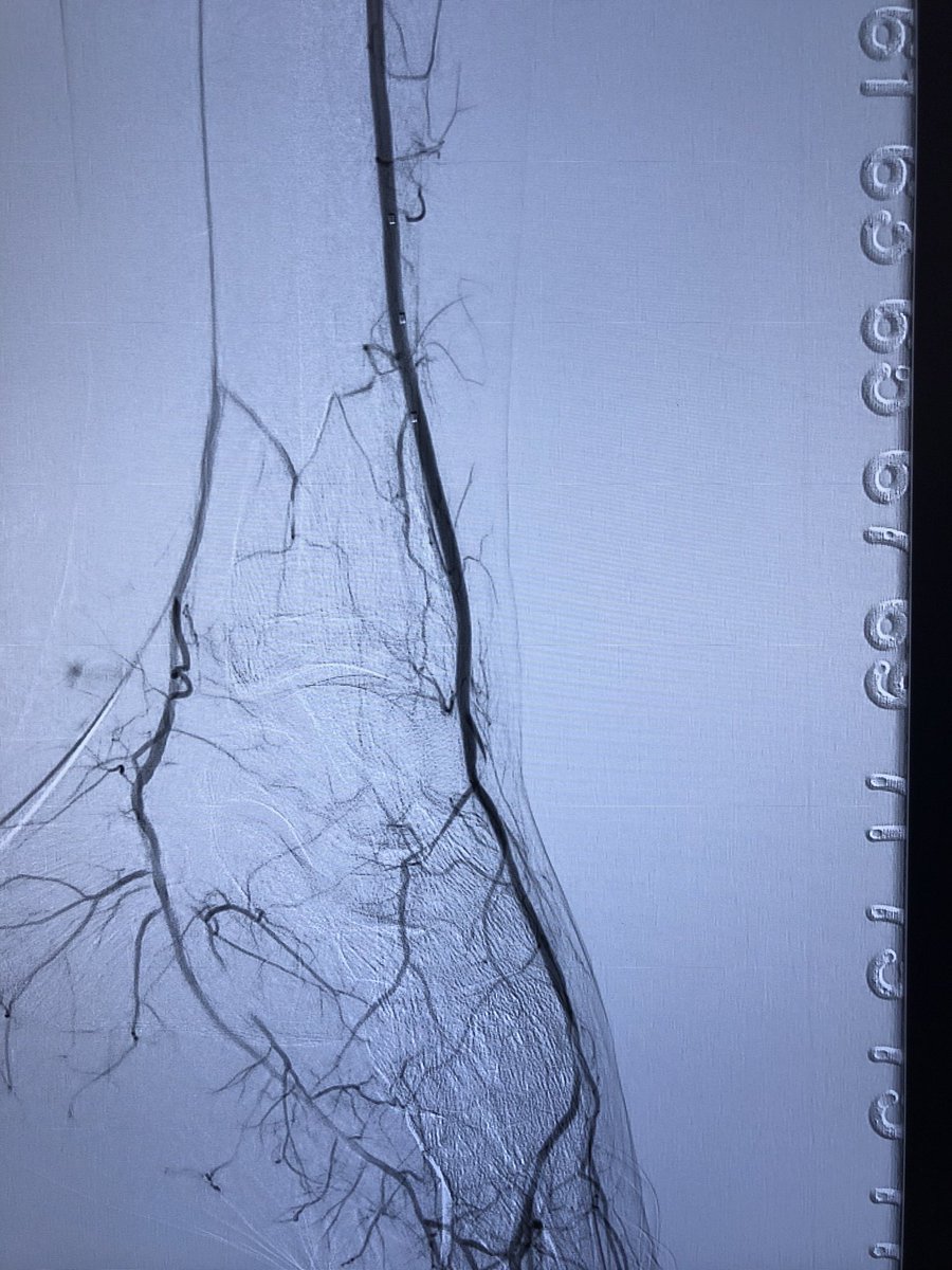ALodha_md's tweet photo. Entire case done from an occluded PT access. Accessed on ultrasound with slender 6fr sheath and treated SFA. Then came around into anterior tibial, crossed the pedal loop into PT and POBA. Patient had excellent infrapop flow after. #cli #pedalfirst #clifighters #pedalloop https://t.co/fTbNehKrlr