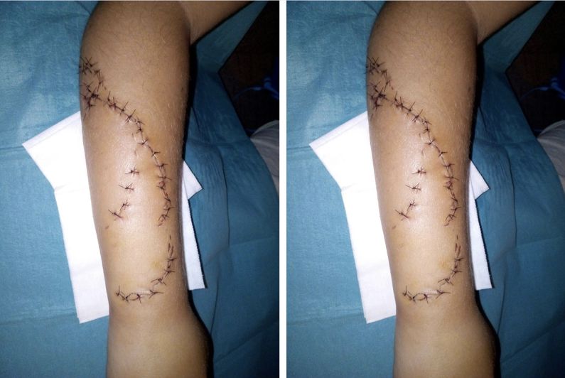 Polynesiela1ere's tweet photo. Le petit garçon mordu par un requin au lagoonarium de Moorea, le 14 novembre dernier, sort de son silence. Tiago s'en sort avec 72 points de sutures et 3 tendons déchirés. La famille porte plainte. https://t.co/5pHdhg5UI0 Tahiti Polynesie https://t.co/Pbt2vYJx0N