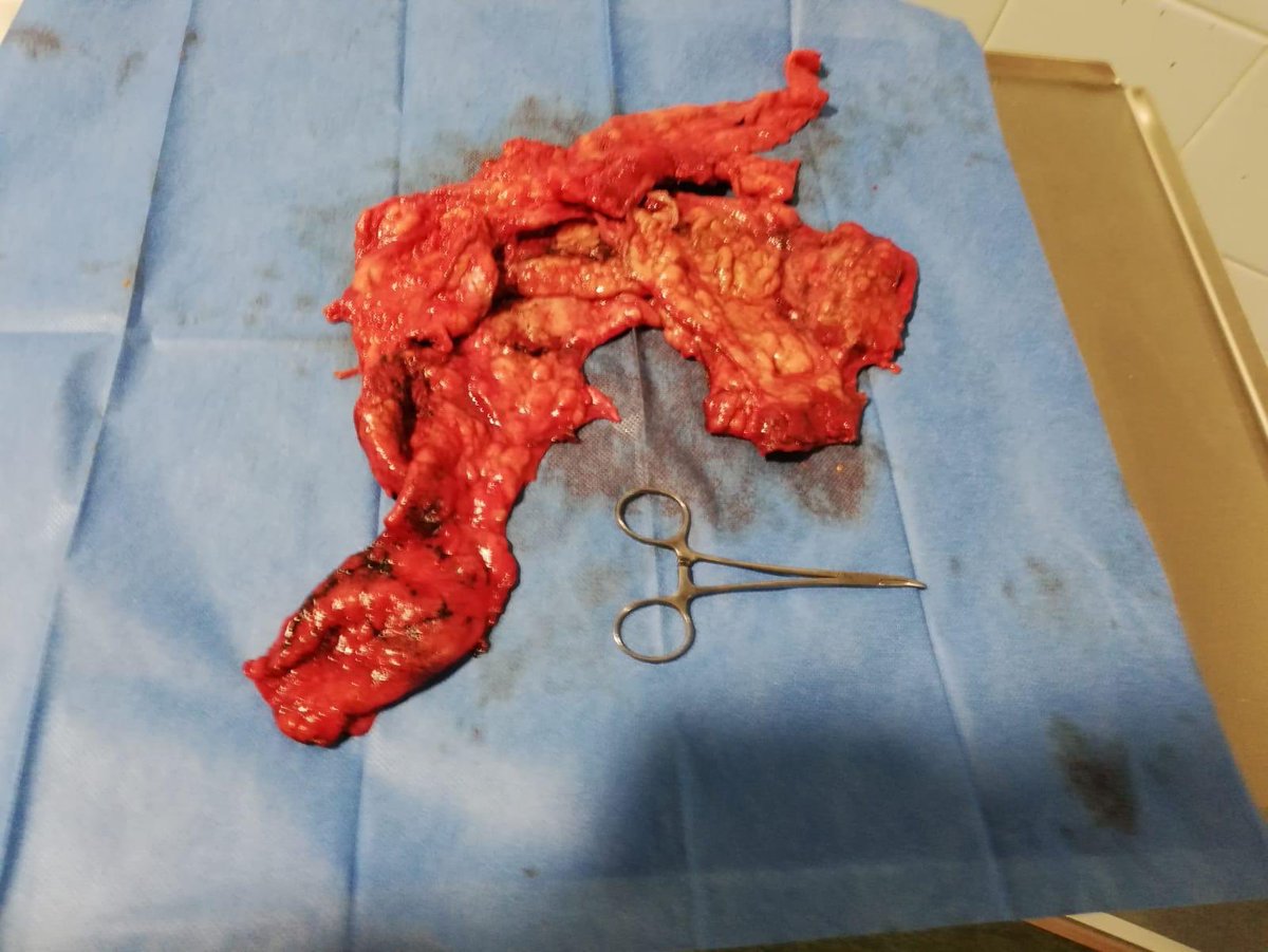 CTObellvitge's tweet photo. Pleurectomia y decorticacion de tumor pleural: Mesotelioma epiteloide 500g. Enfermedad en auge, cada vez operamos más casos. #thoracicsurgery #cirugiatoracica #mesothelioma https://t.co/kUMgi1j0g8