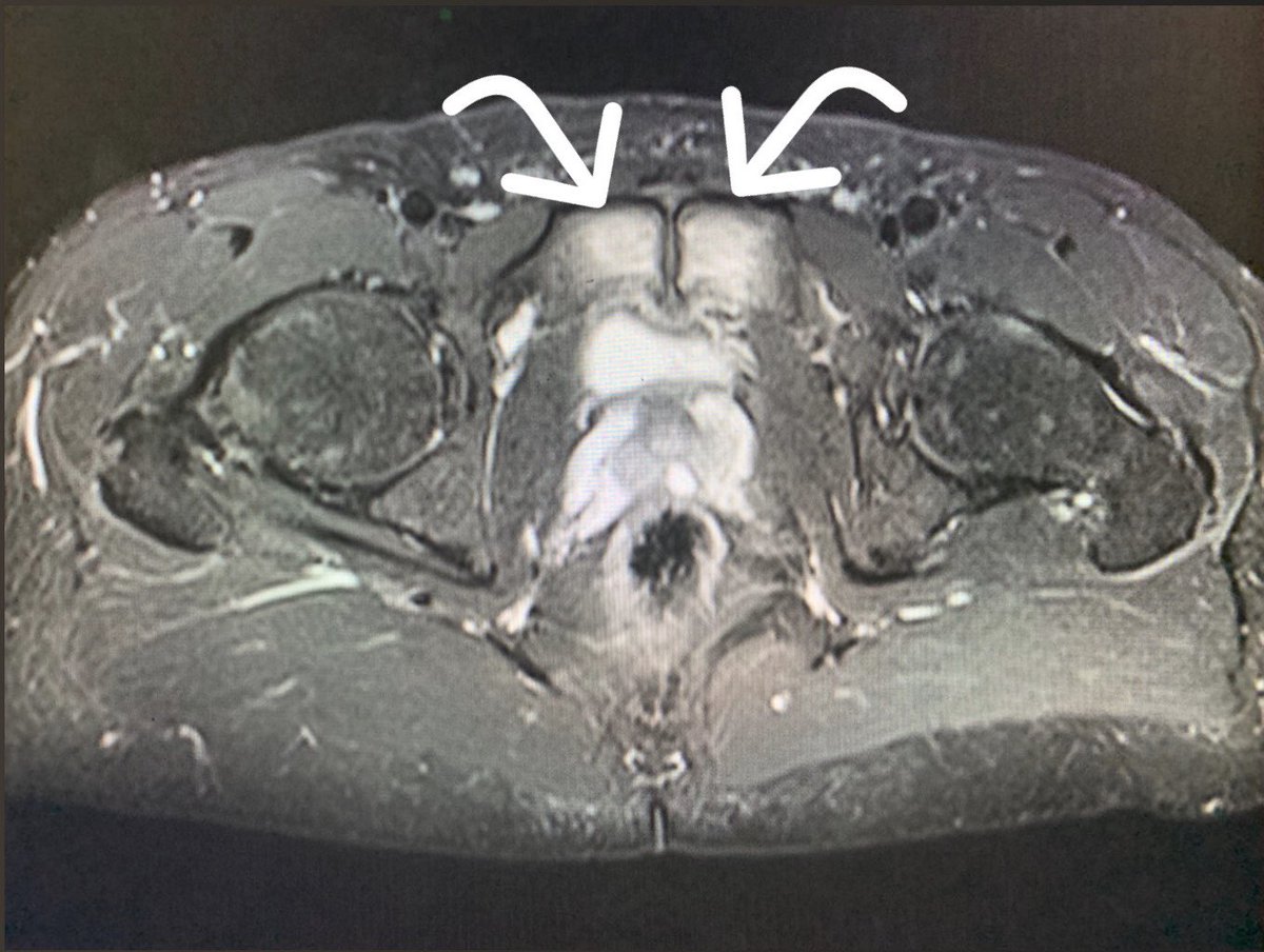 Sport_Ex_Dr's tweet image. Beautiful MRI example of pubic bone stress, higher grade on the left with more intense signal changes. Presented as groin/adductor related pain with running. Pain ++ palpating adductors and pubic bones