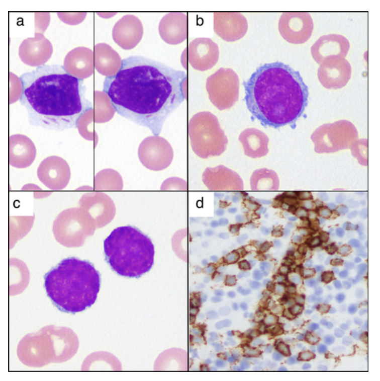 feldstej's tweet photo. #auerrods ?lymphocytes ?hairy cells ? monocytes

Sojitra P, et al. Pathol Int. 2017. https://t.co/FsLwA5ichk