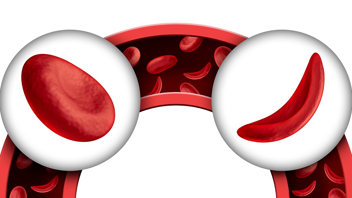 FDA_Drug_Info's tweet photo. #FDAapproves new drug for the treatment of sickle cell disease in adults and pediatric patients 12 years of age and older: https://t.co/ATNDJSkVac. https://t.co/ywyYphJR81