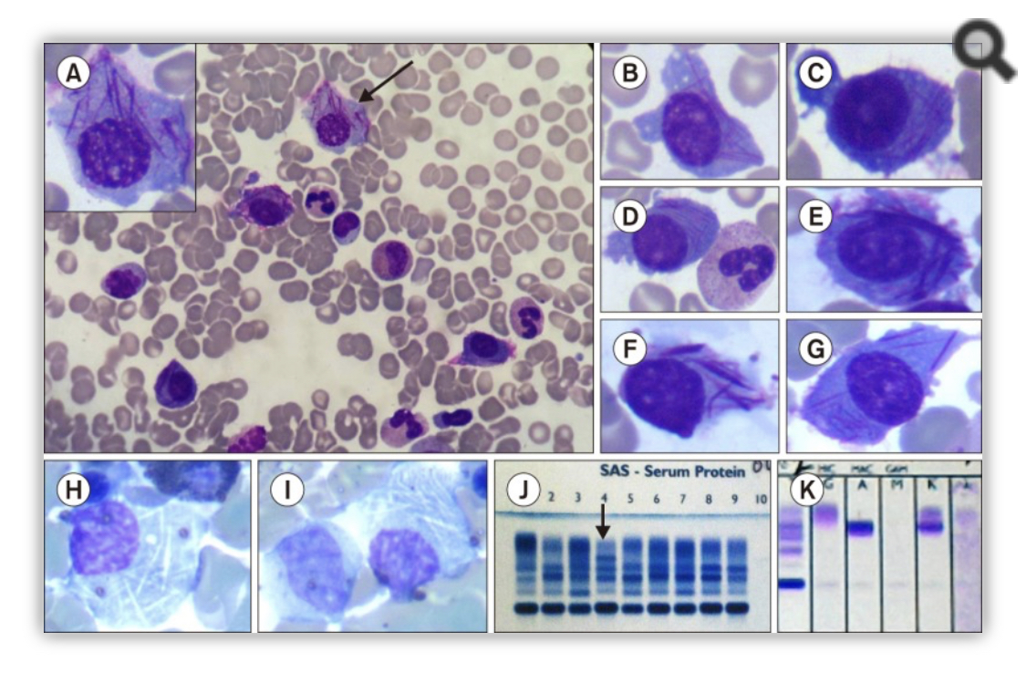 feldstej's tweet photo. #auerrods ?myeloid ?lymphoid ?plasma cells 

Dass J, et al. Blood Res. 2018. https://t.co/iGMTor0gDV