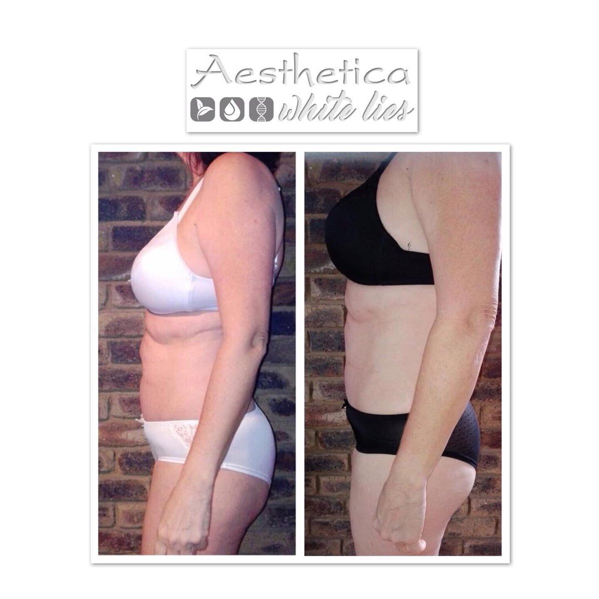 SkinAesthetica's tweet image. #skin2go #velashape3 #anticellulite #lovetheskinyourein #cellulitetreatment VelaShape™III theskincentre.co.za/products/velas… via @Aesthetica Skin Centre