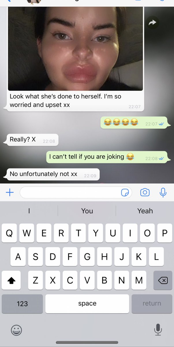 lucy_tough's tweet photo. Na sorry I can’t cope😩 Had my filler done Saturday nd sent my mother a picture and she has text my sister this thinking it’s real 😭😭😭😭😭😭😭 https://t.co/REpByN8DMx